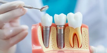 he Dental Implant Consultation Checklist: Questions To Ask Before Treatment