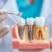 he Dental Implant Consultation Checklist: Questions To Ask Before Treatment