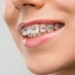 Modern Orthodontics